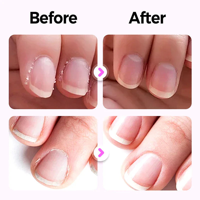 VeraNail™ Precision Pen — Transform Weak, Cracked Nails into Silky-Strong Gems You’ll Flaunt Proudly