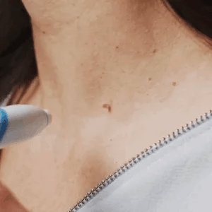 LumaClear™ — Reveal Smooth, Flawless Skin Fast Without Pain or Scars