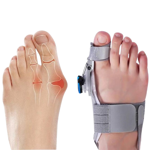 Bunion Corrector Toe Spacer | Adjustable Hinge Realignment | Silicone Pads & Heel Strap