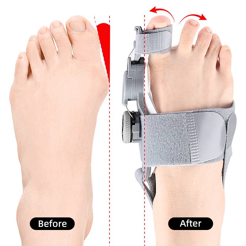 Bunion Corrector Toe Spacer | Adjustable Hinge Realignment | Silicone Pads & Heel Strap