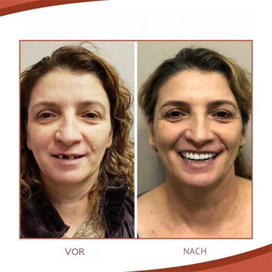 Denture Set | Biocompatible Silicone Prosthesis | Natural-Looking Teeth | Comfortable Fit