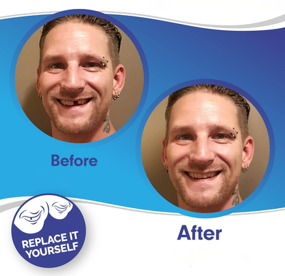 Snap-On Veneers (Upper & Lower) | Natural-Looking Finish | Silicone Liner | Comfortable Fit