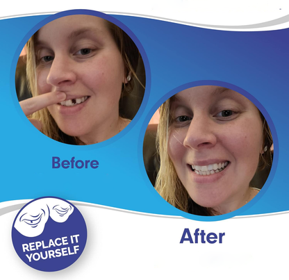 Snap-On Veneers (Upper & Lower) | Natural-Looking Finish | Silicone Liner | Comfortable Fit
