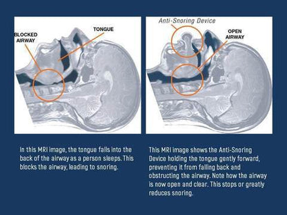 Tongue Stabilizing Device | Suction Anti-Snore Design | Medical-Grade Silicone & Comfortable Fit