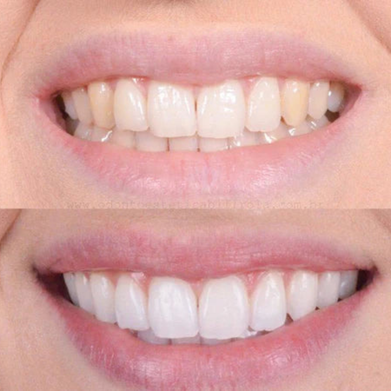 LumaShine™ — Unleash a Radiant Smile That Commands Attention Instantly
