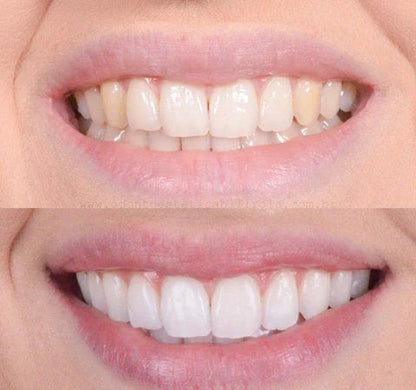 GlowWhiten | Teeth Whitener