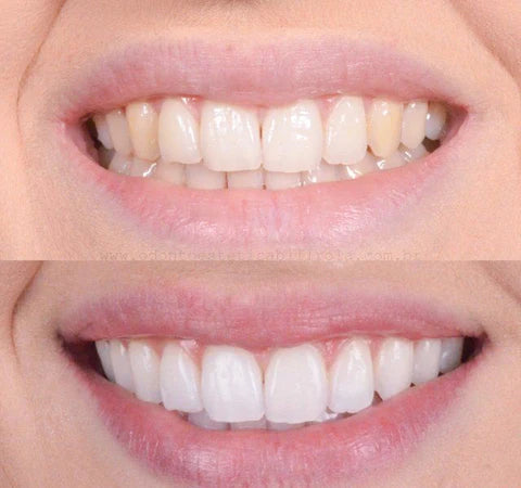 RadiancePulse™ — Unleash a Radiant, Pain-Free Smile That Commands Attention